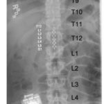 X-ray of electrode array for epidural stimulation