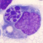 Image of macrophage digesting apoptotic, or dead cell