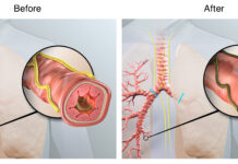 Targeted lung denervation (TLD) is designed to disrupt pulmonary nerve reflexes, which may have the potential to reduce COPD exacerbations. Illustration courtesy Nuvaira Inc.